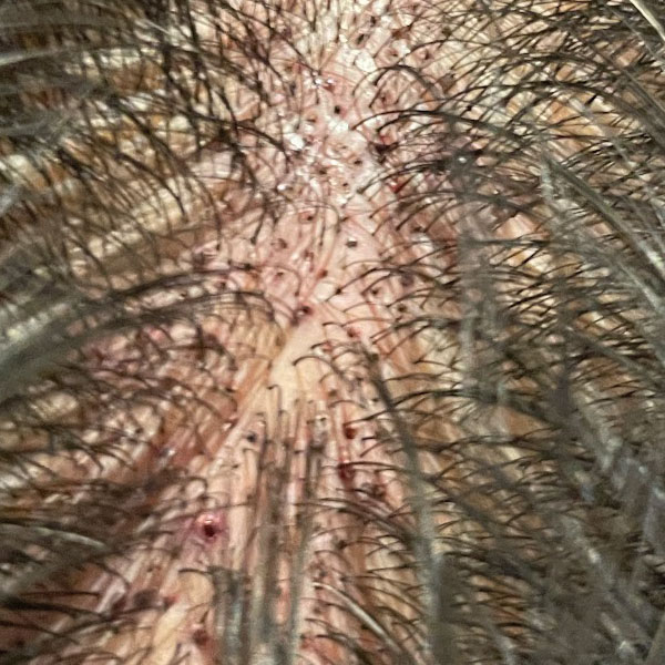 自毛植毛術翌日の移植部位の状態